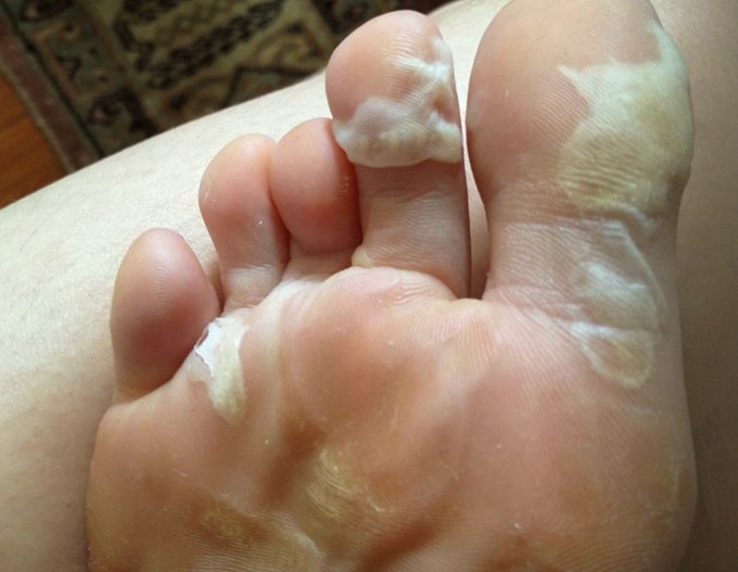 foot-skin-peeling-treatment-1-min